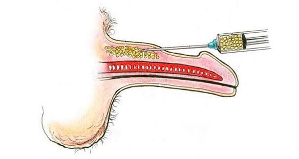 Hyaluronic acid injections into the barrel of a member in order to increase it